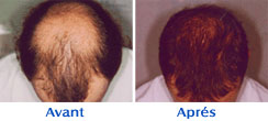 Microgreffe des cheveux